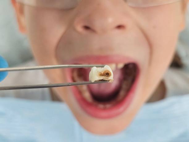 Best Emergency Tooth Extraction in Harrington Park, NJ